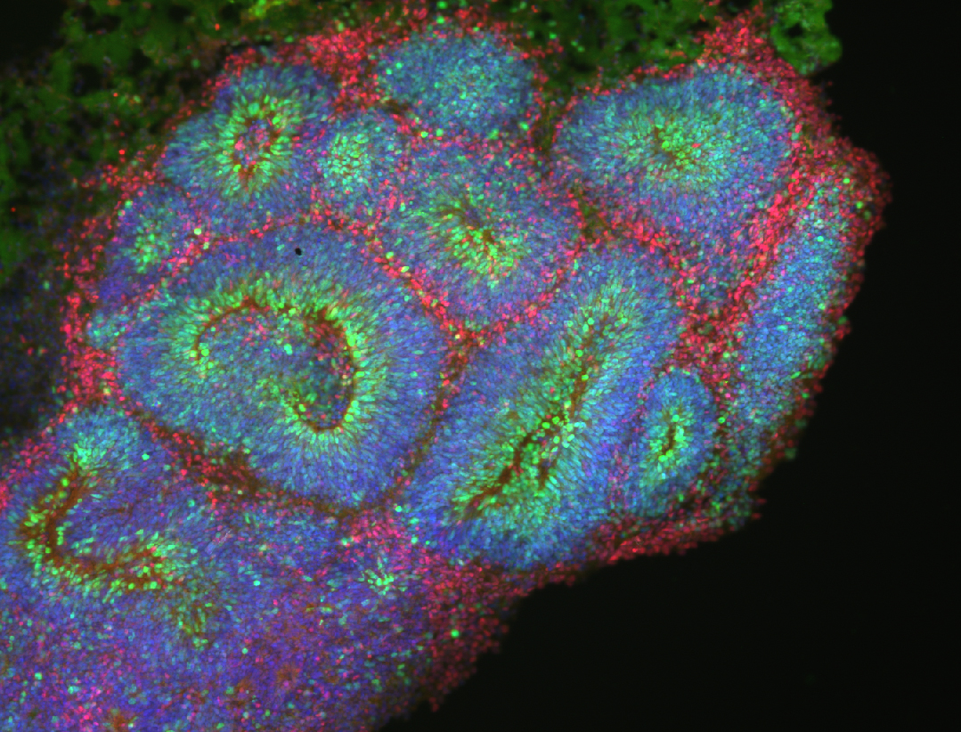 A ‘cerebral organoid’ after 30 days of culture grown from stem cells by Selina Wray and colleagues at UCL. Image: Christopher Lovejoy and Charlie Arber, UCL Institute of Neurology.