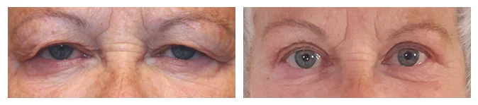 Before/After