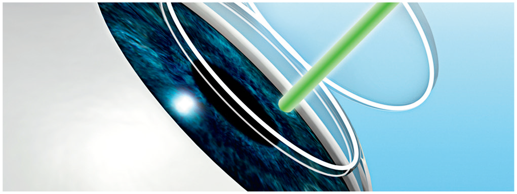step3_lasik.png