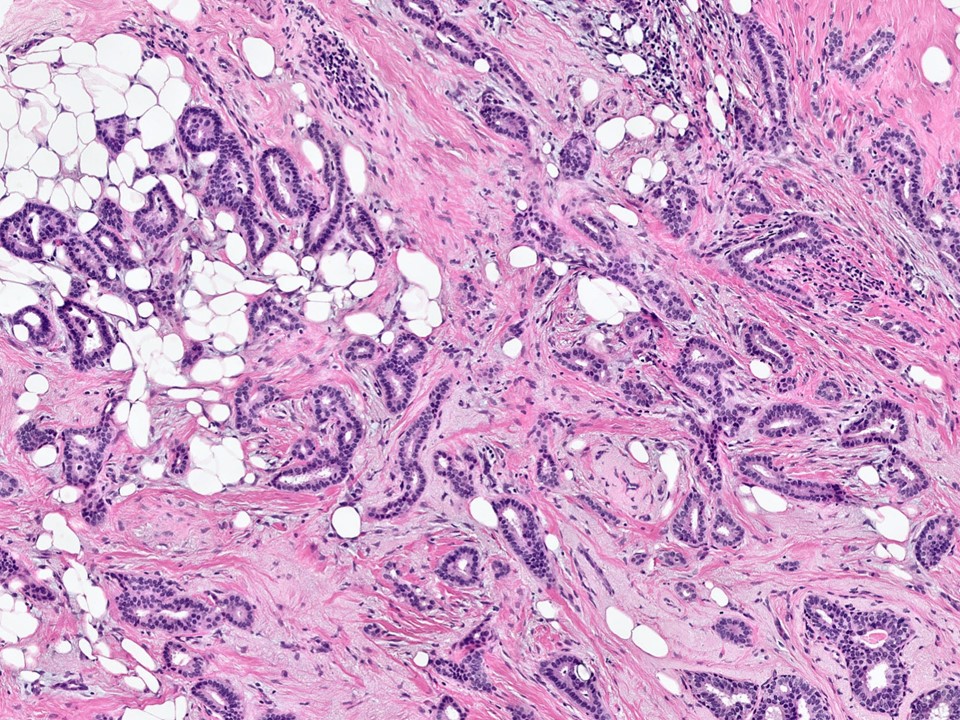 Carcinoma icon.jpg