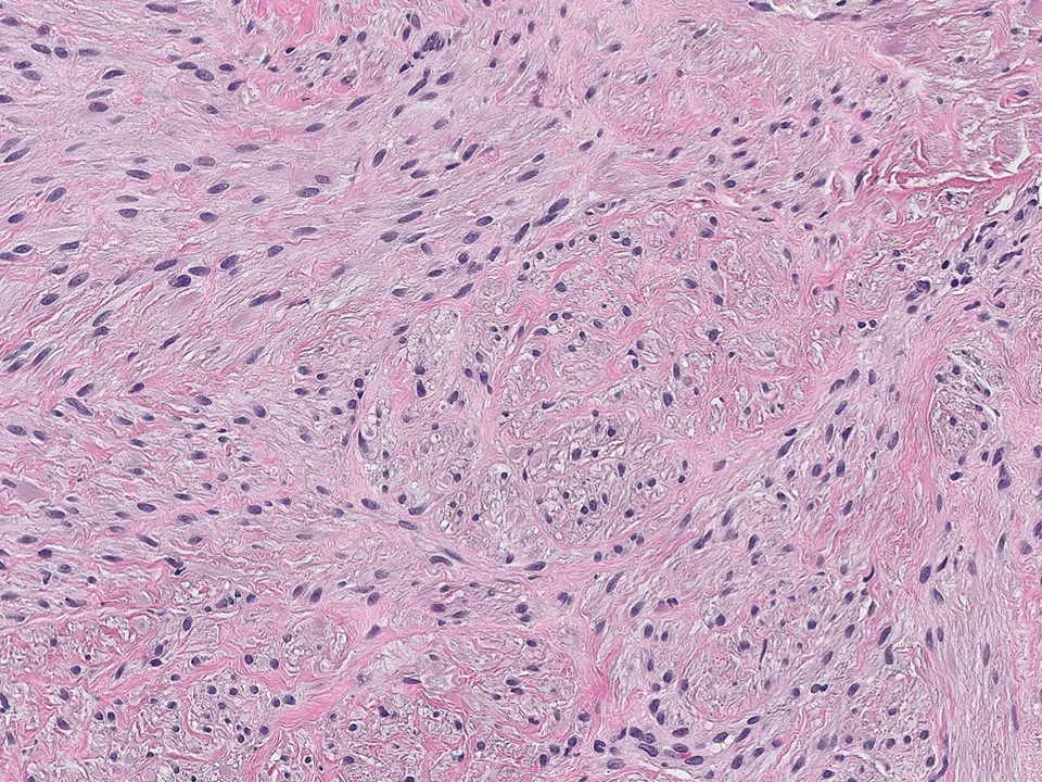 Myofiboblastoma Icon.jpg