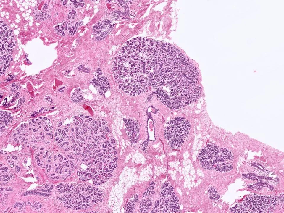 Normal Breast Tissue