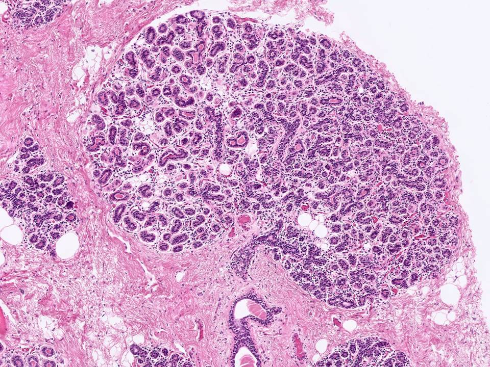 Normal Breast Tissue, Lobule with Terminal Duct