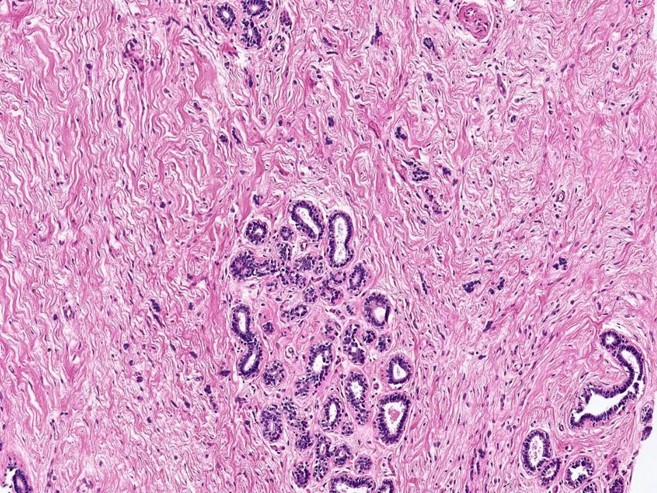Multinucleated Stromal Giant Cells