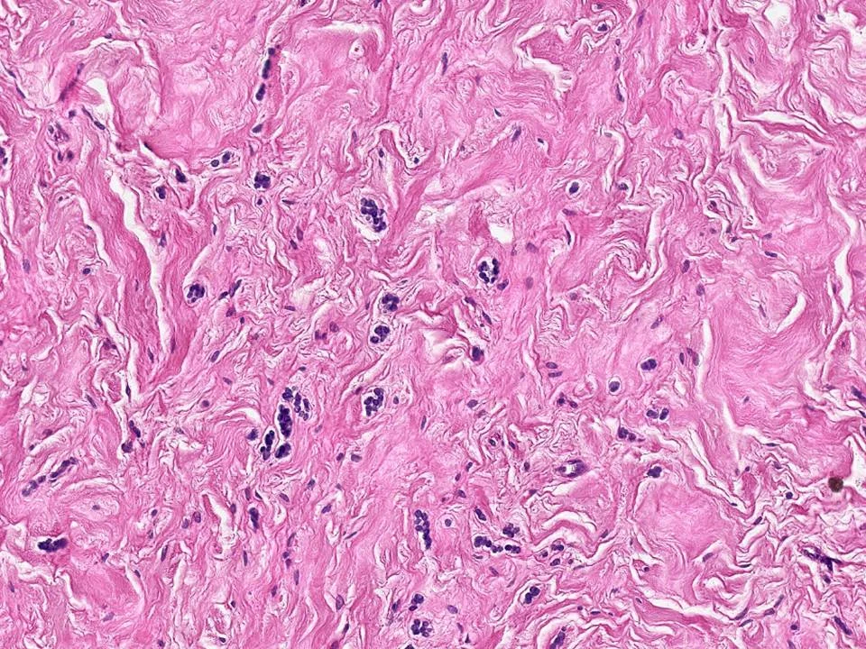 Multinucleated Stromal Giant Cells
