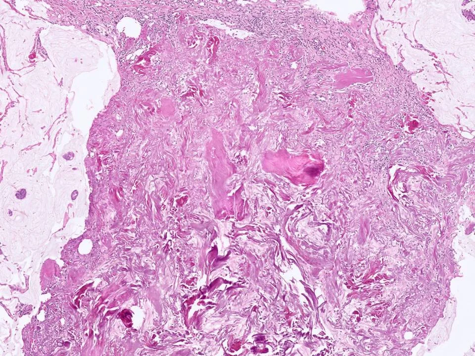 Collagen Plug