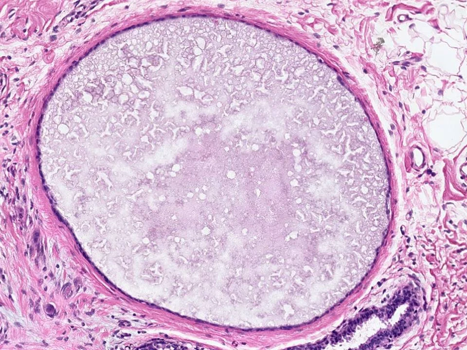 Cyst