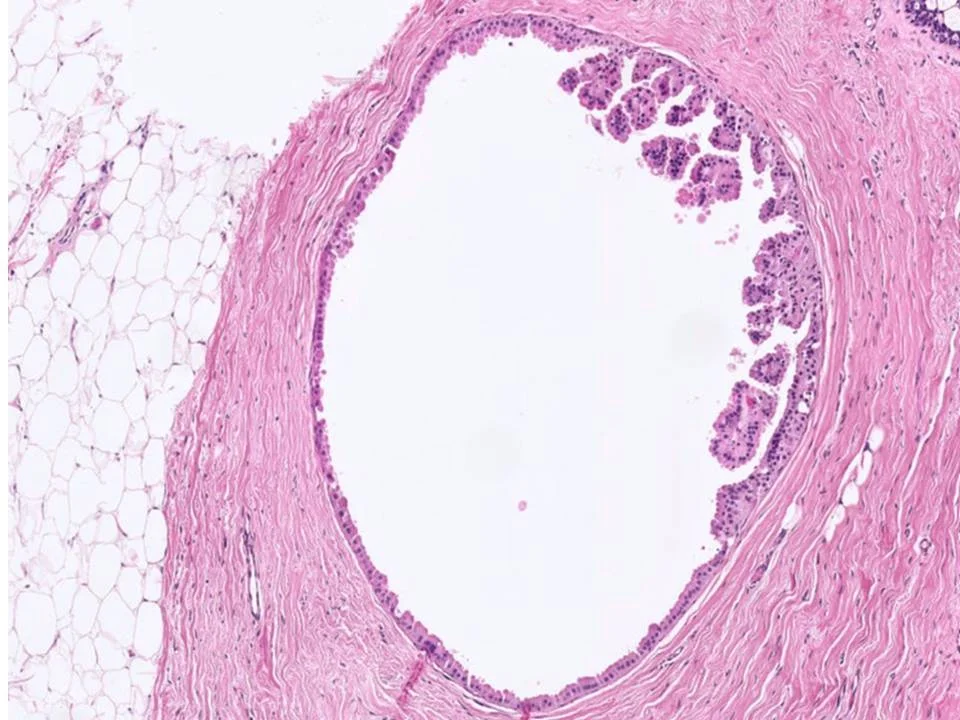 Papillary Apocrine Change