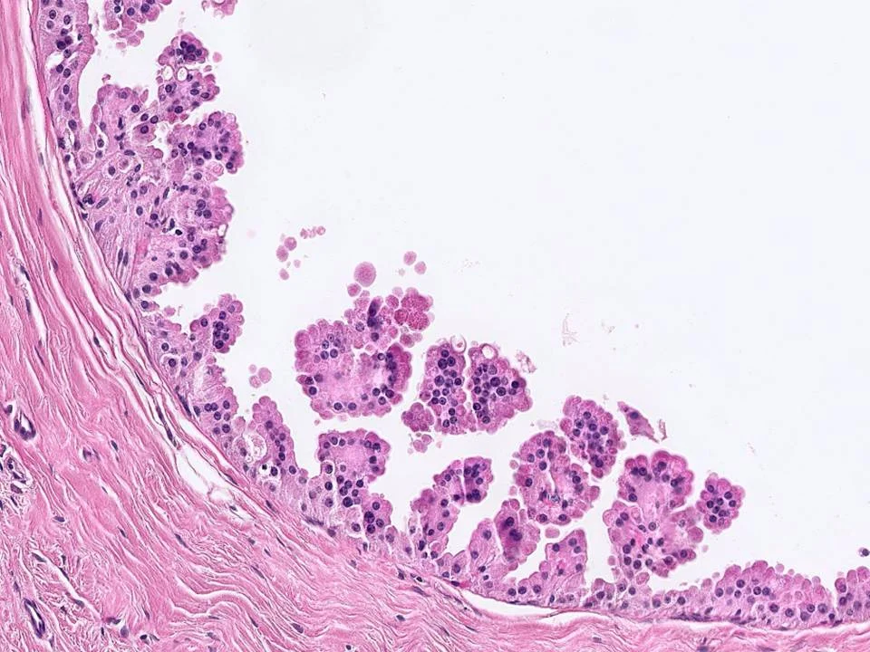 Papillary Apocrine Change