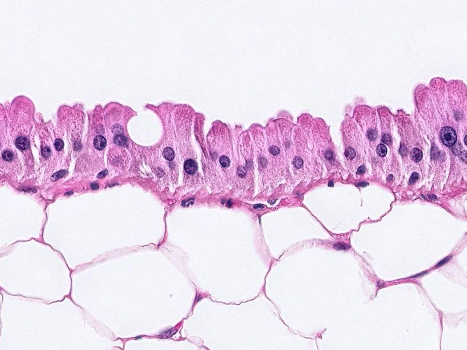 Apocrine Metaplasia