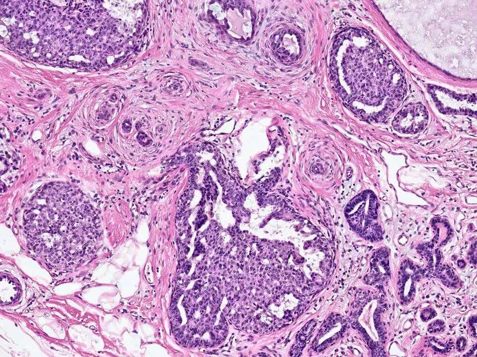 Usual Ductal Hyperplasia