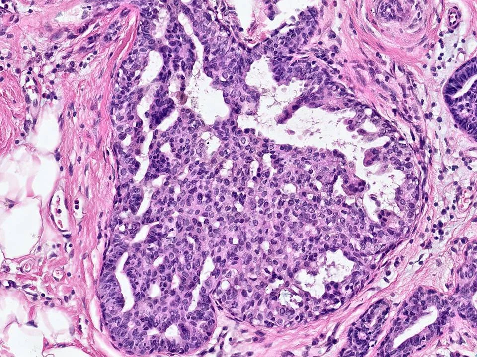 Usual Ductal Hyperplasia
