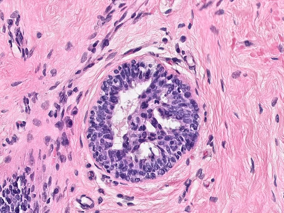 Usual Ductal Hyperplasia