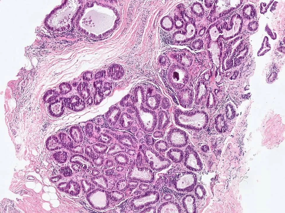 Flat Epithelial Atypia