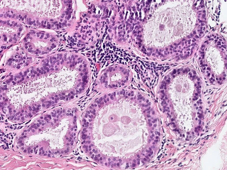 Flat Epithelial Atypia