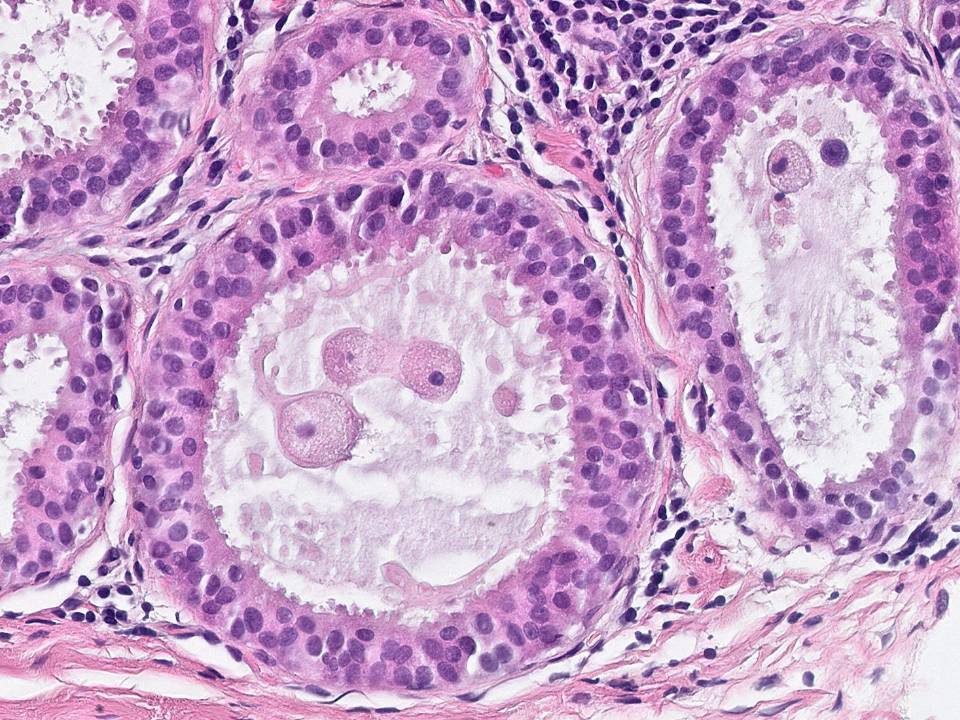 Flat Epithelial Atypia