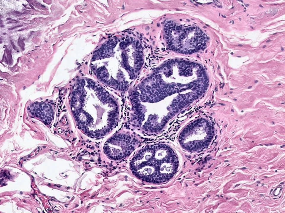 Atypical Ductal Hyperplasia Arising in a Background of Flat Epithelial Atypia