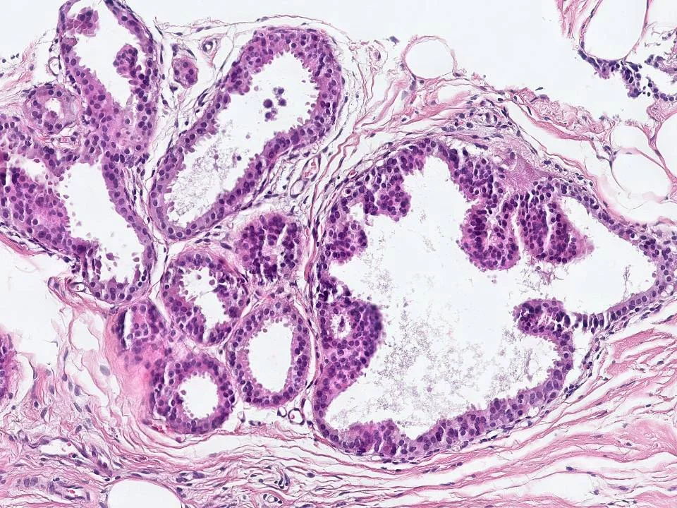 Atypical Ductal Hyperplasia Arising in a Background of Flat Epithelial Atypia