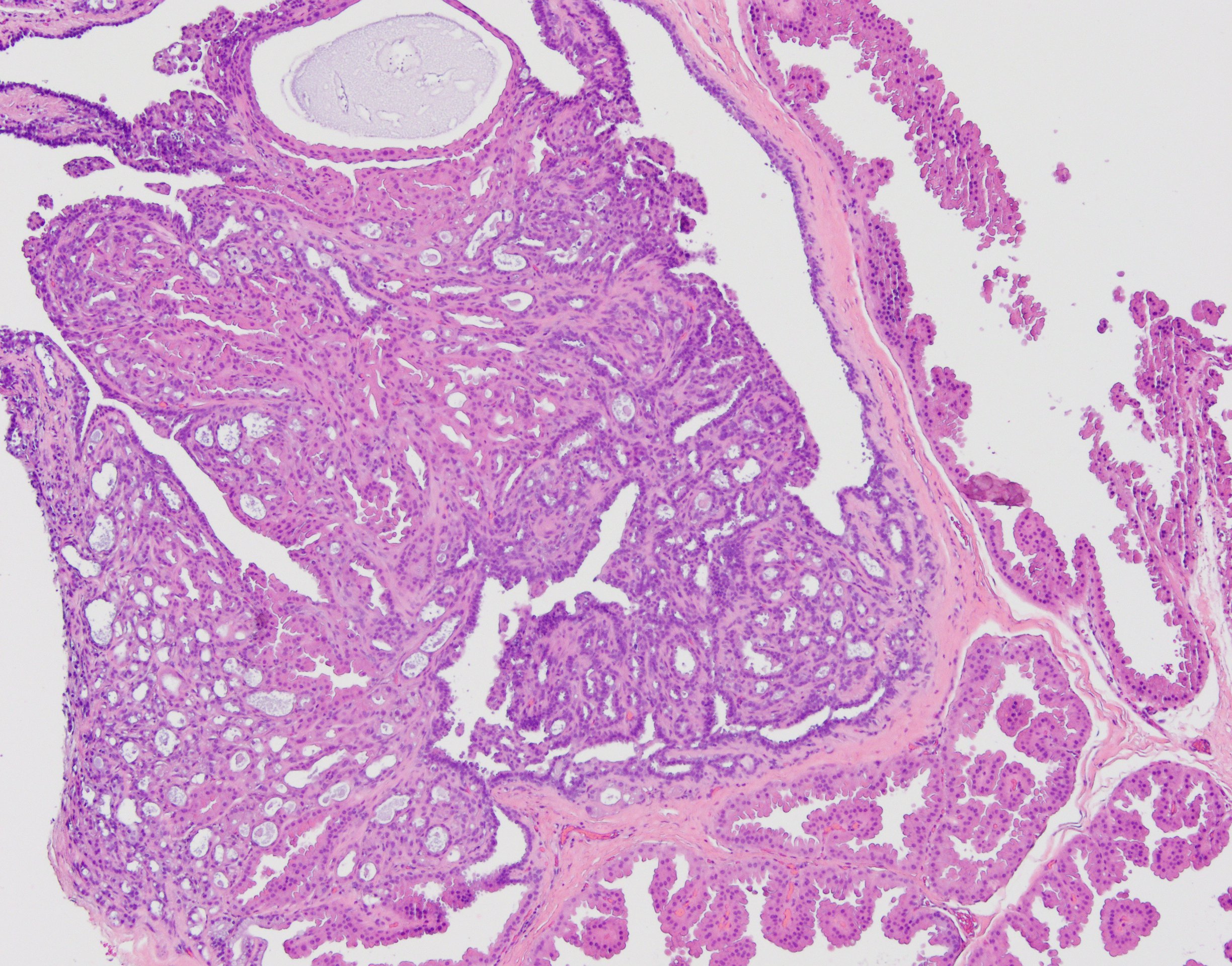 Atypical papillary neoplasm - Papillary lesion with apocrine metaplasia