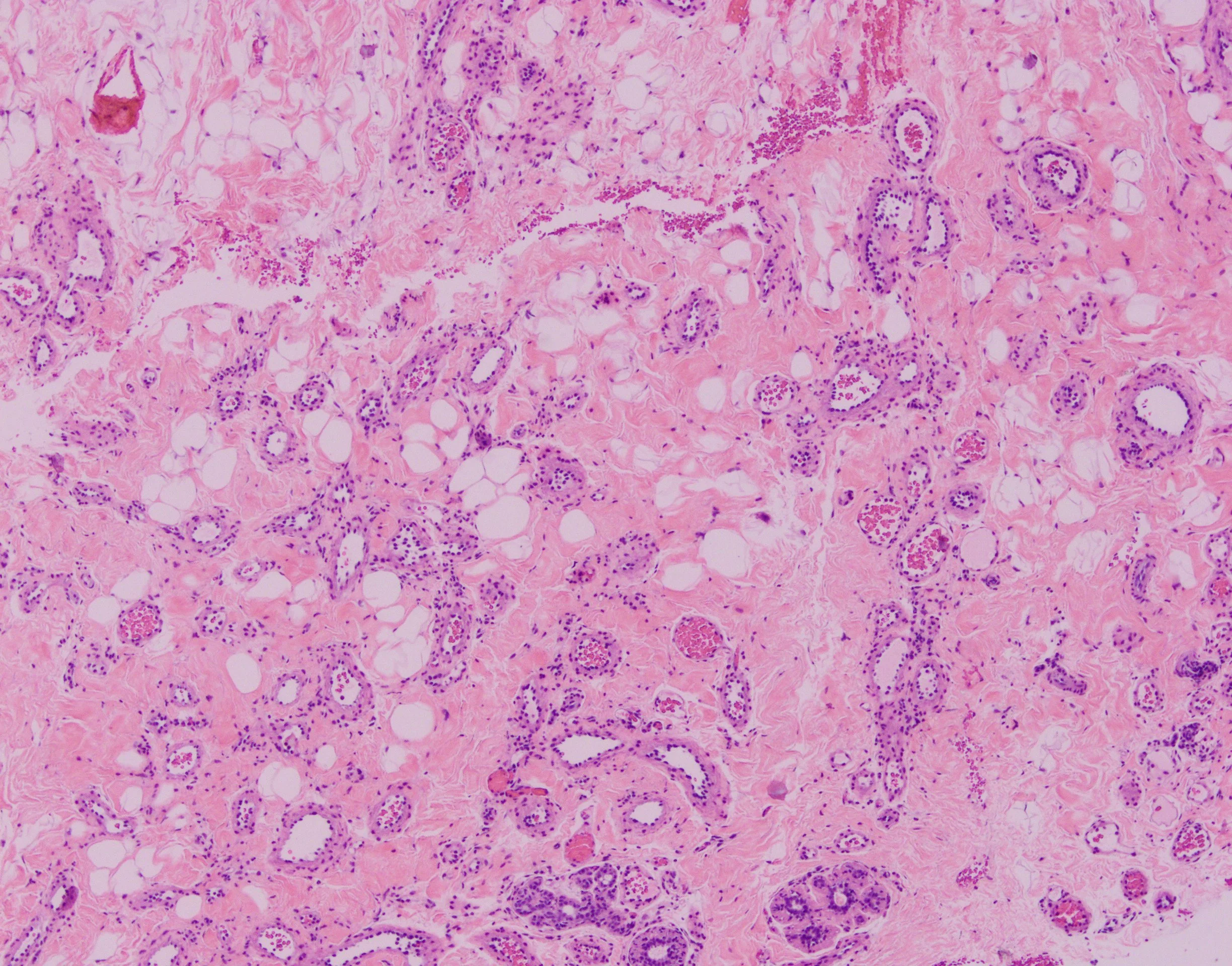 Hemangioma