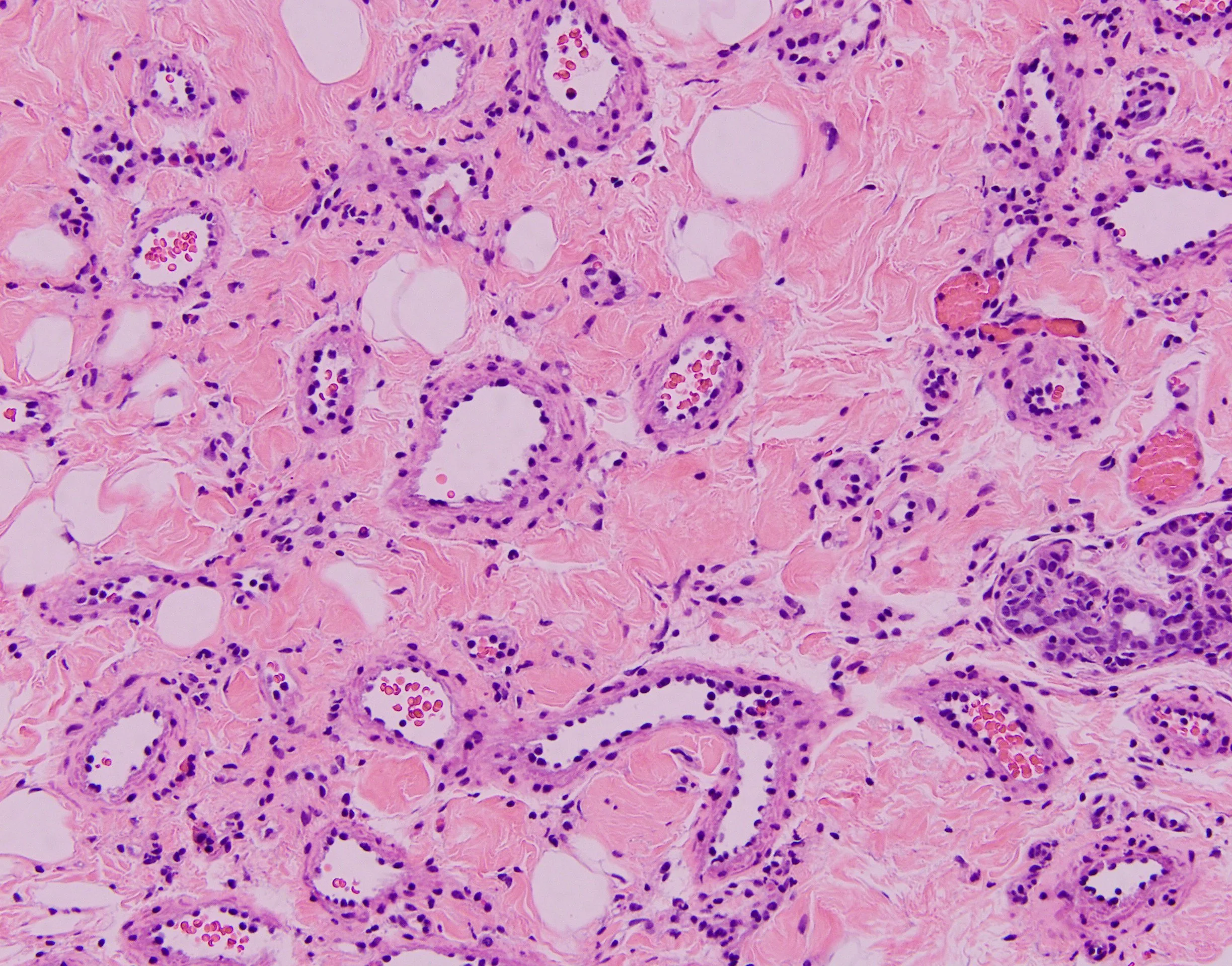 Hemangioma