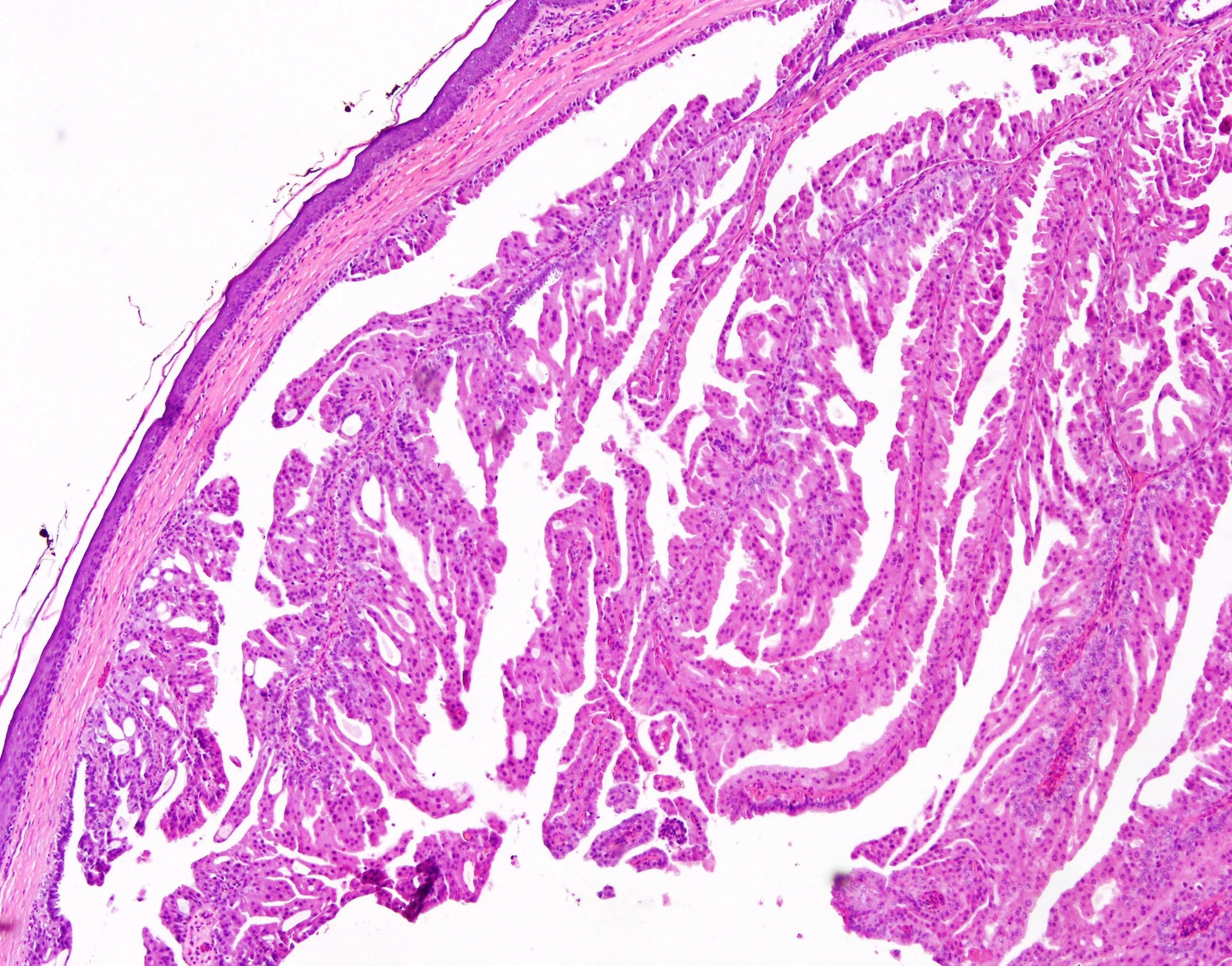 SC16-31471 Nipple Intraductal papilloma w florid DH and AM2.jpg