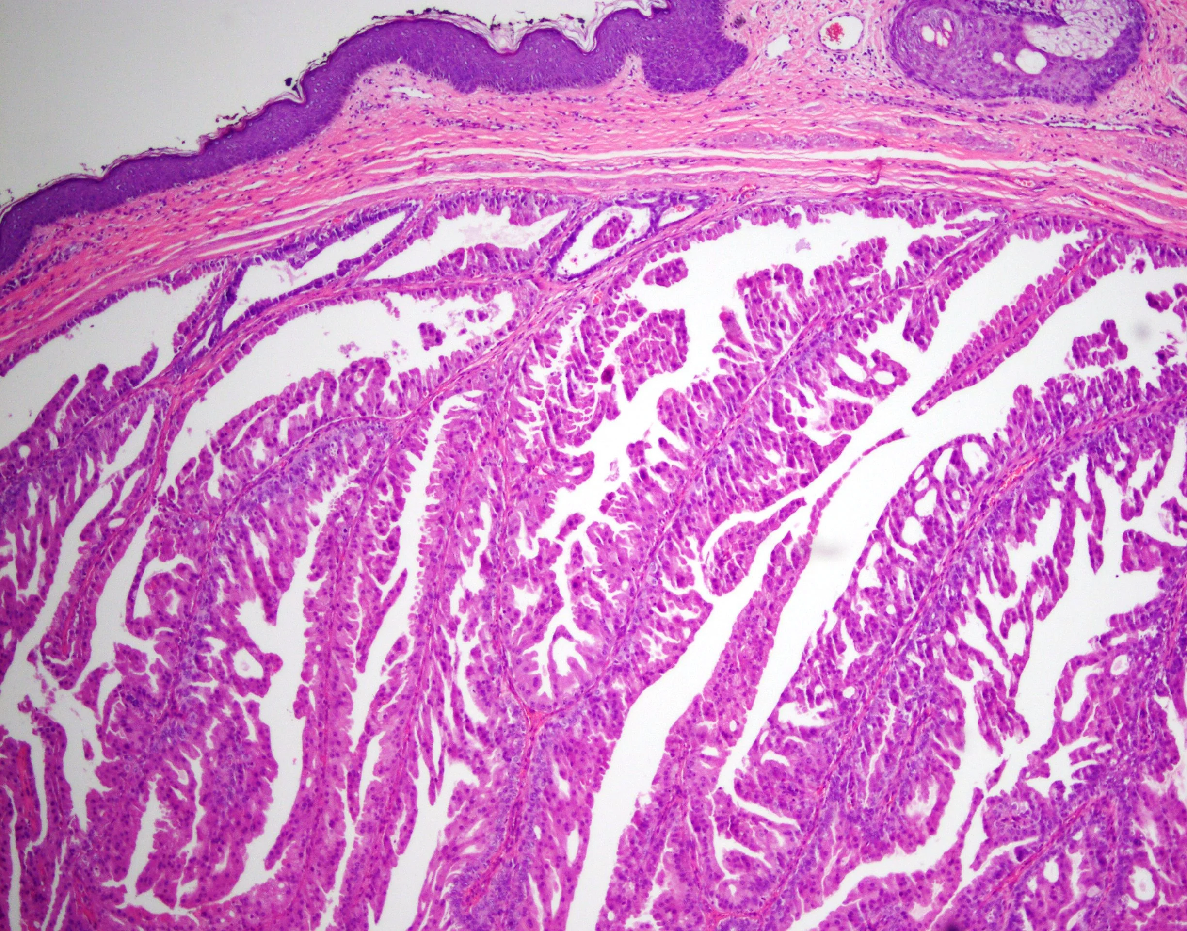 SC16-31471 Nipple Intraductal papilloma w florid DH and AM4.jpg