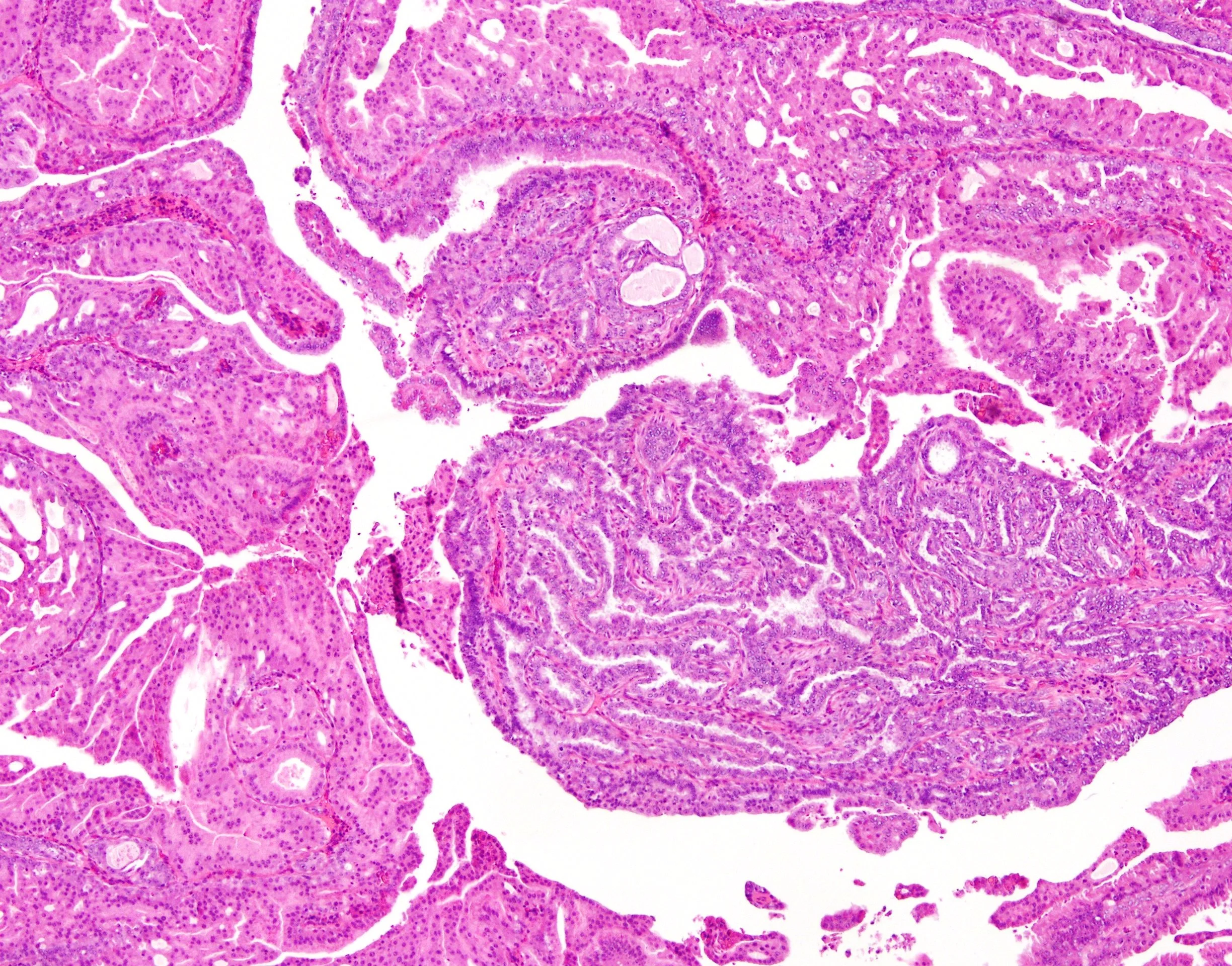 SC16-31471 Nipple Intraductal papilloma w florid DH and AM3.jpg