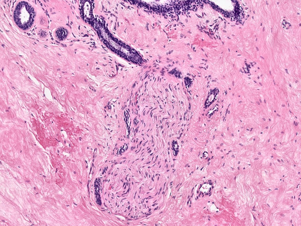 Adenosis with Perineural Involvement