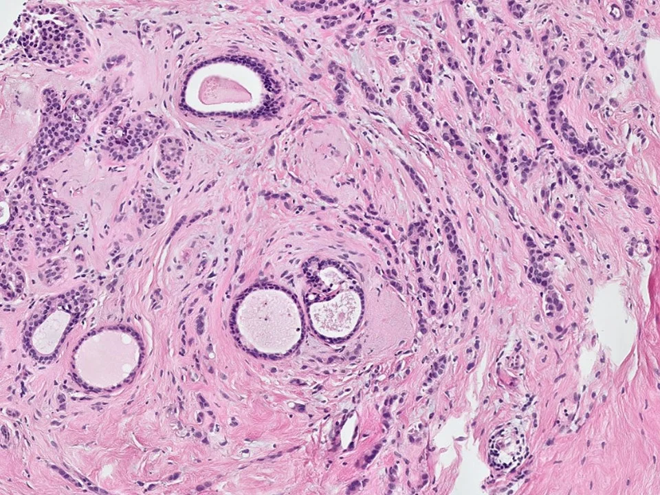 Invasive Lobular Carcinoma
