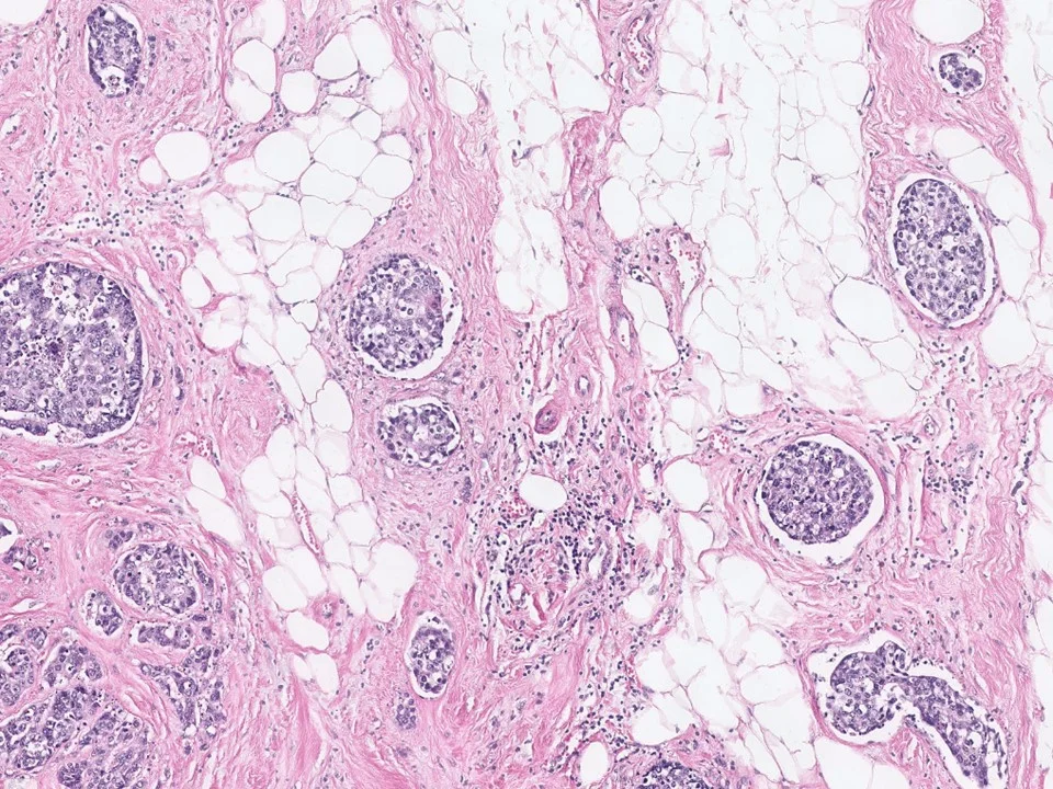 Invasive Ductal Carcinoma, Grade 3, With Extensive Lymphovascular Invasion