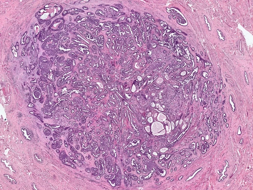 Nipple Adenoma
