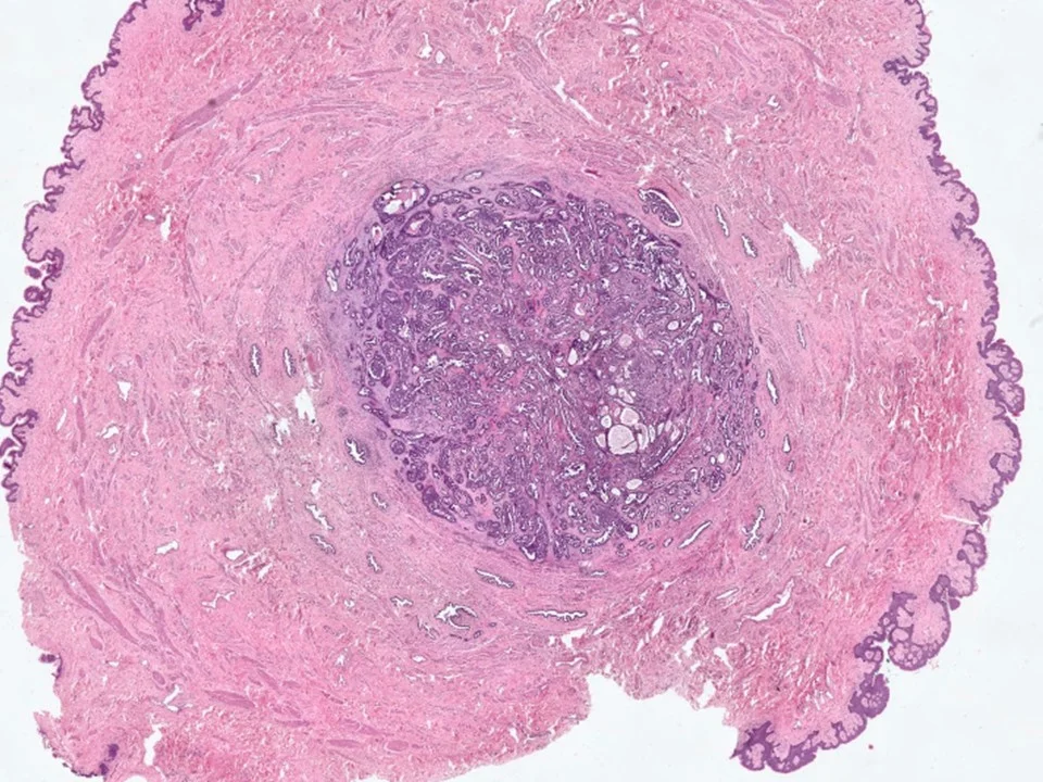 Nipple Adenoma