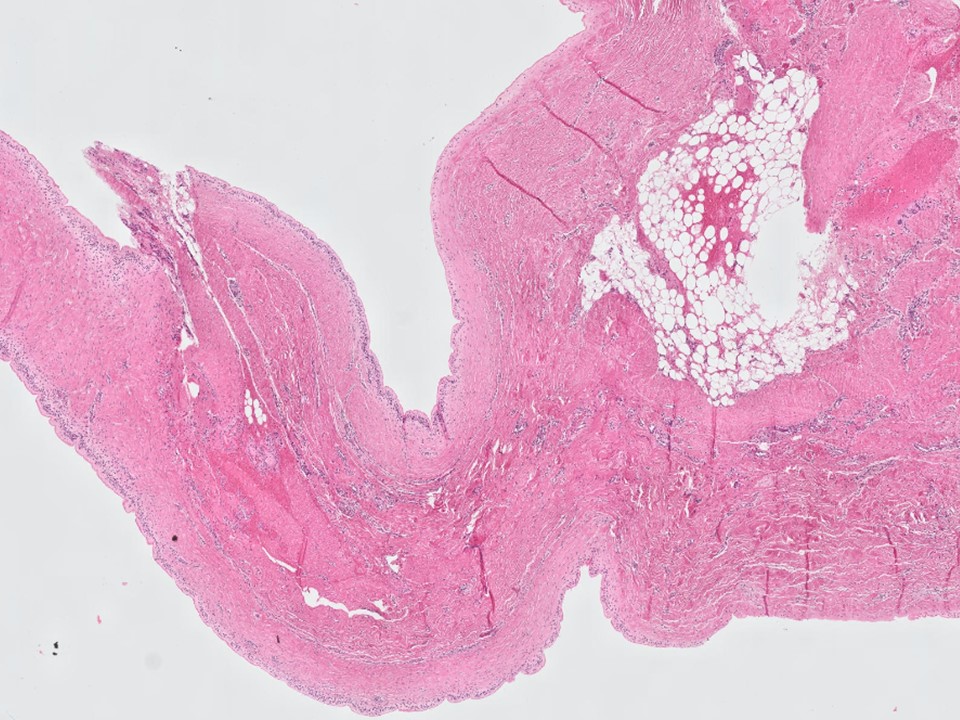 Breast Implant Capsule With Synovial Metaplasia