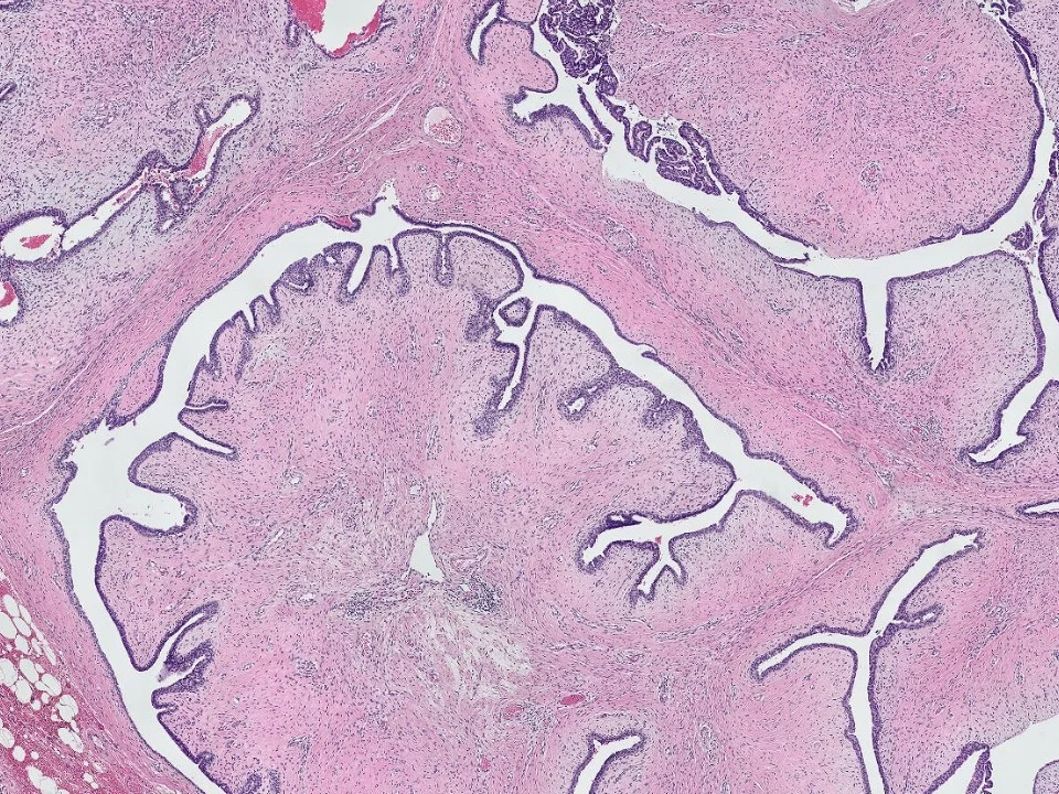 Benign Phyllodes Tumor