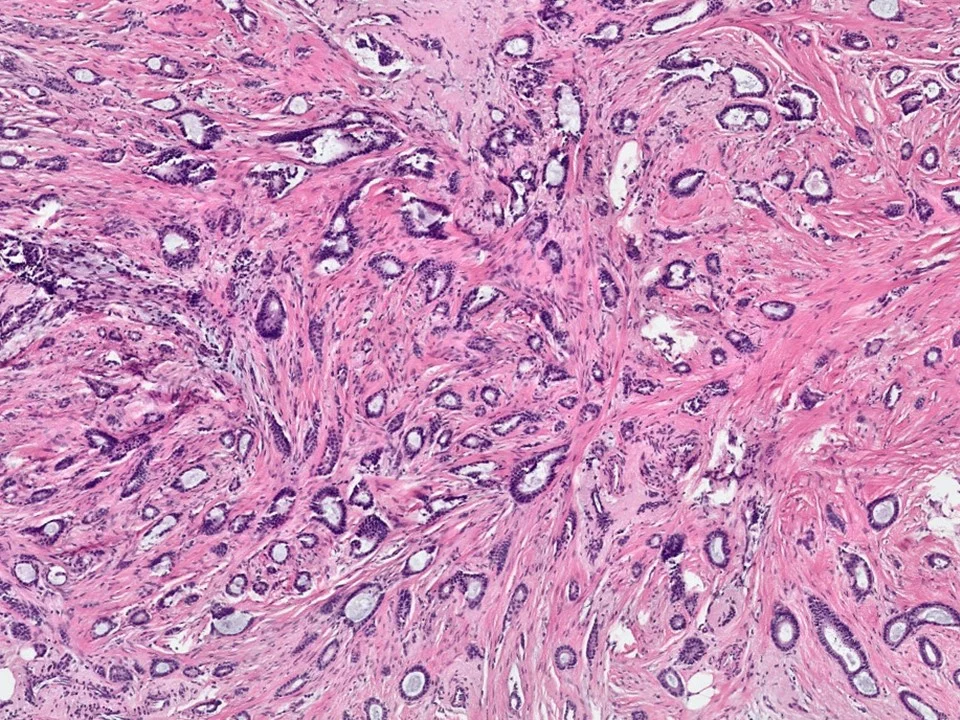 Tubular Carcinoma