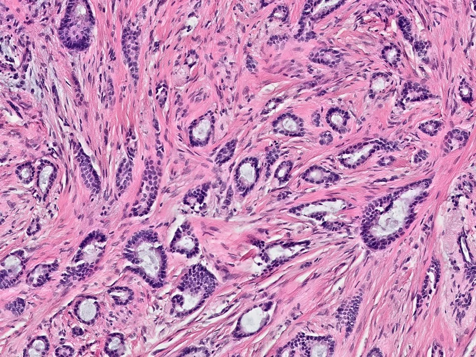 Tubular Carcinoma