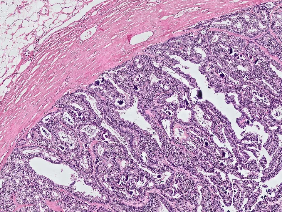 Encapsulated Papillary Carcinoma