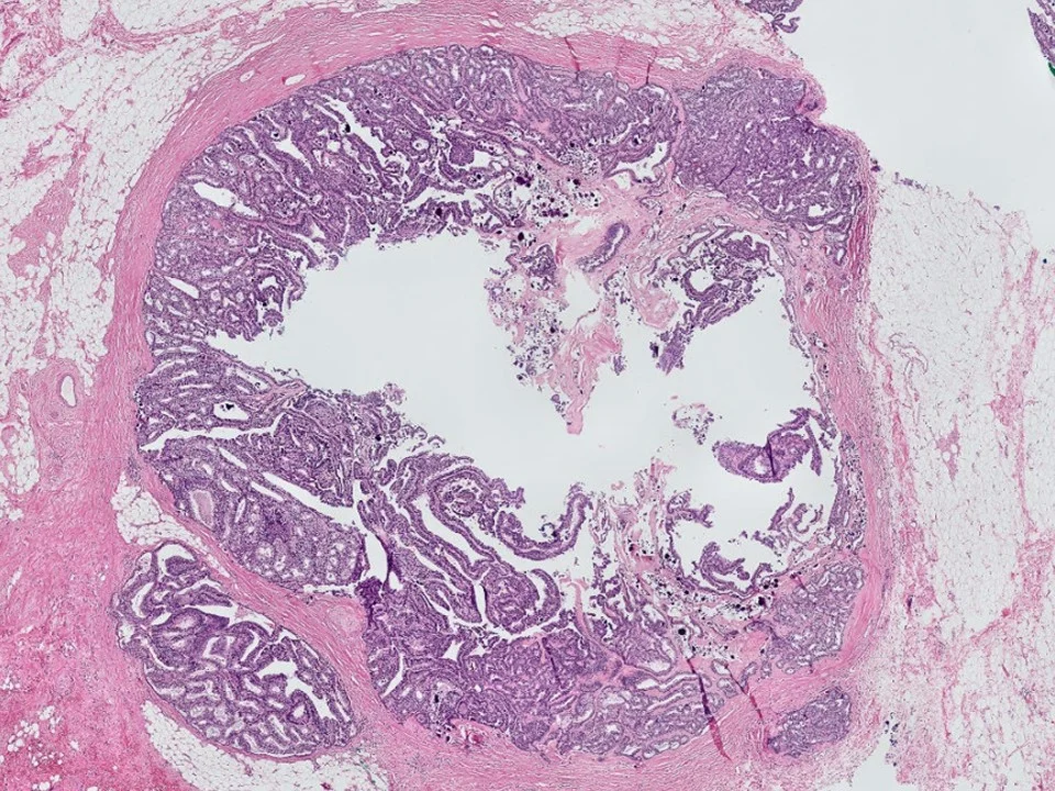 Encapsulated Papillary Carcinoma