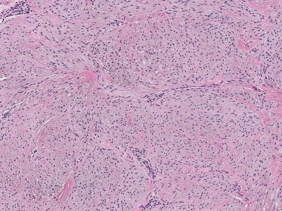 Myofibroblastoma
