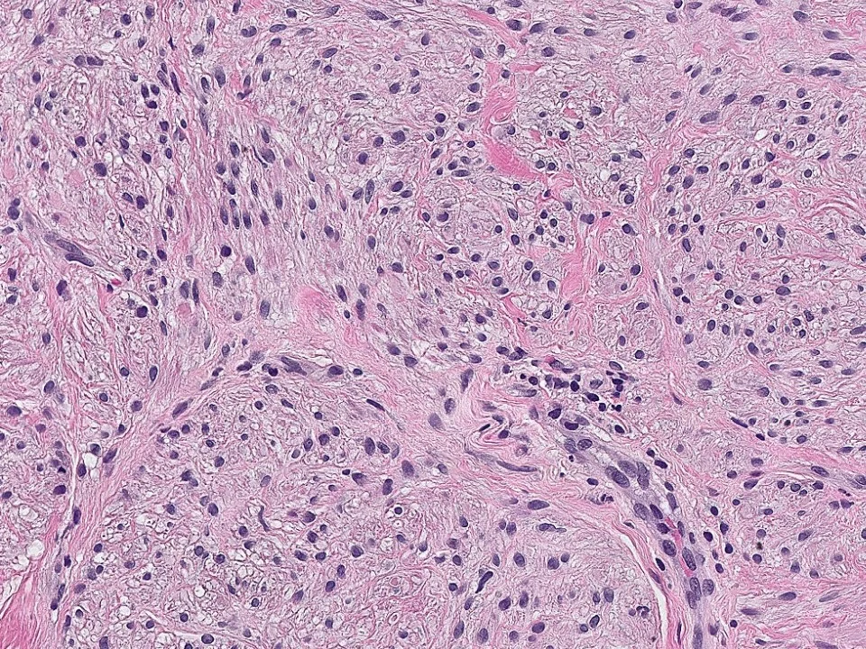 Myofibroblastoma