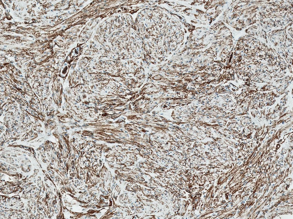Myofibroblastoma, CD34