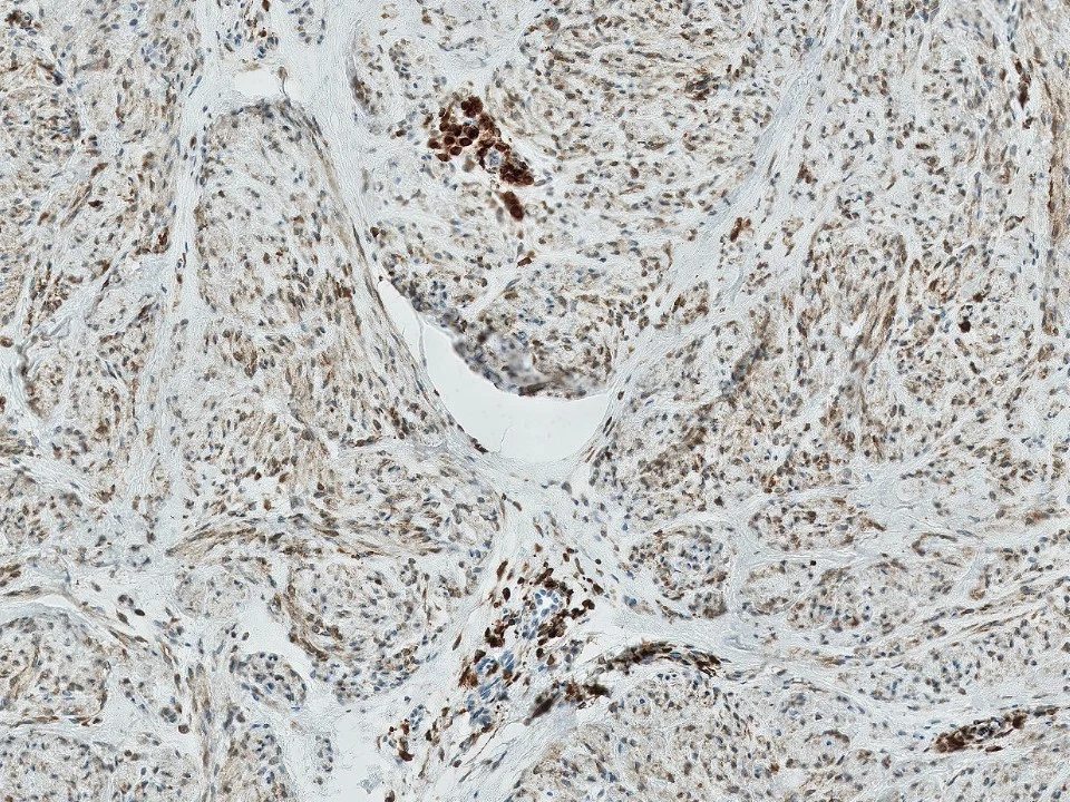 Myofibroblastoma, BCL2