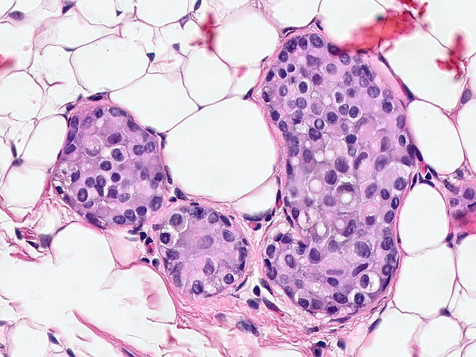Atypical Lobular Hyperplasia