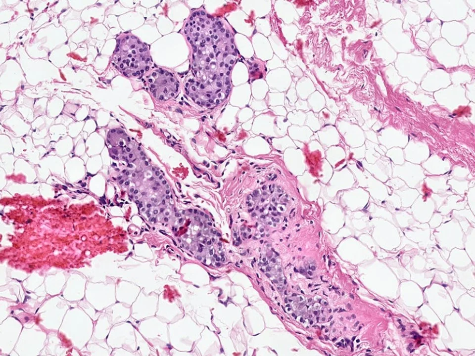 Atypical Lobular Hyperplasia