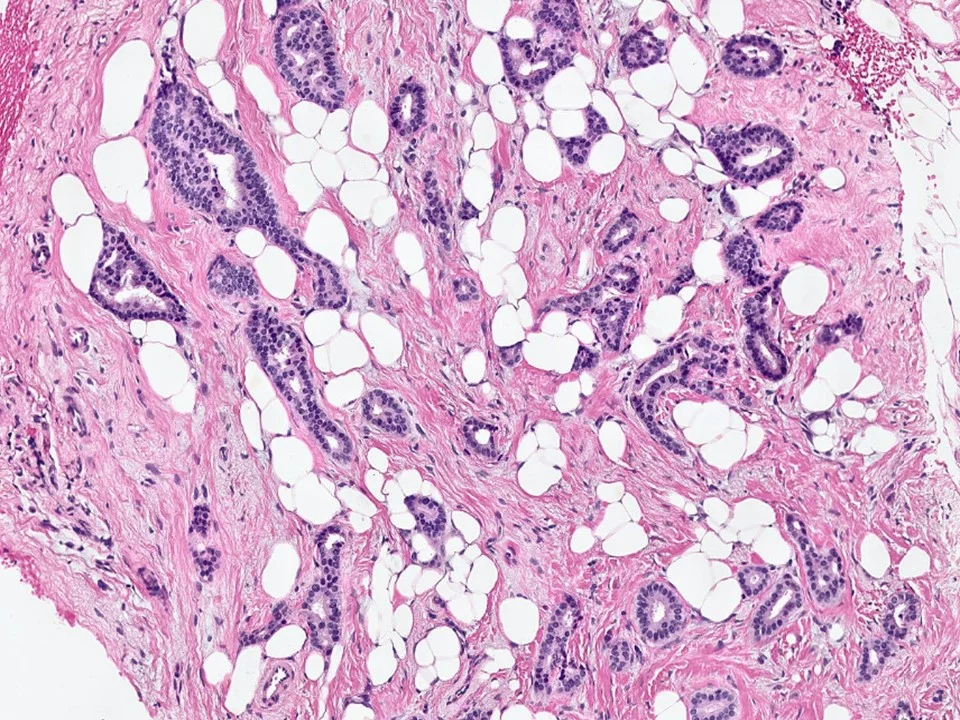 Tubular Carcinoma