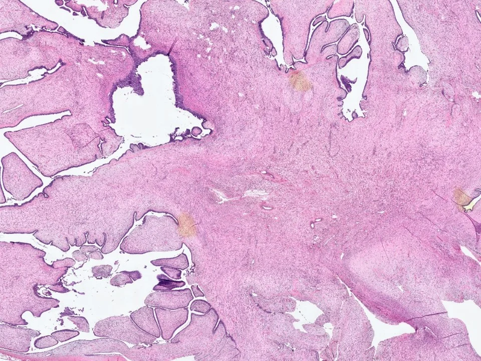 Malignant Phyllodes Tumor