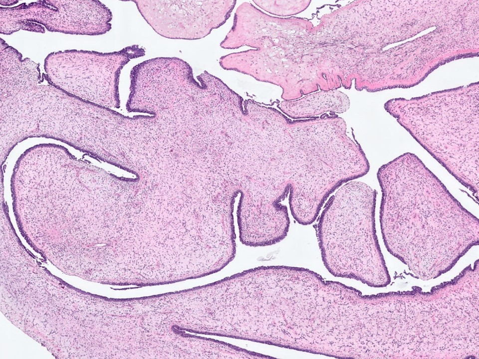 Malignant Phyllodes Tumor