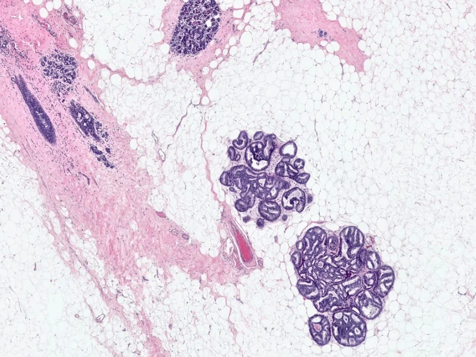Atypical Ductal Hyperplasia