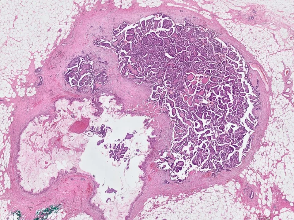 Encapsulated Papillary Carcinoma